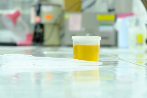 urine sample on table in laboratory with pipette next to it.