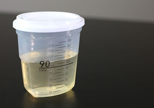Urine in collection cup